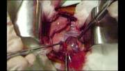 Cirugía de Hemianuloplastia Mitral en Canino