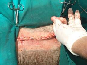 Corrección quirúrgica del desplazamiento inicial del abomaso a la derecha (DAD). Mediante abomasopexia con abordaje paramedial derecho.