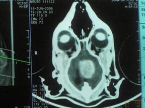 Tomografía cerebral de un gato, corte dorsal, en donde se observa un meningioma del falx cerebral.
