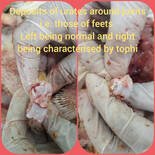 Deposits of urates around joints i.e. those of feets  Left being normal and right being characterised by tophi