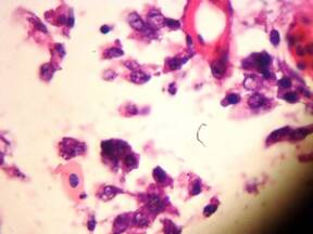 Are these ILT inclusions as I saw in HP of trachea???
