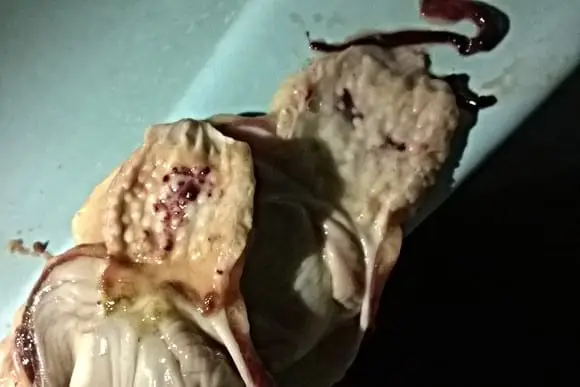 Thick haemorrhage & Erosion of the proventri - Poultry Diseases(daily collection while performing post mortem)