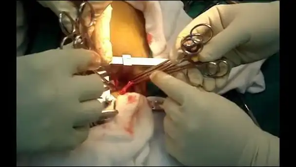 Masa en atrio derecho y cirugía de tórax  (Ventana Pericárdica)
